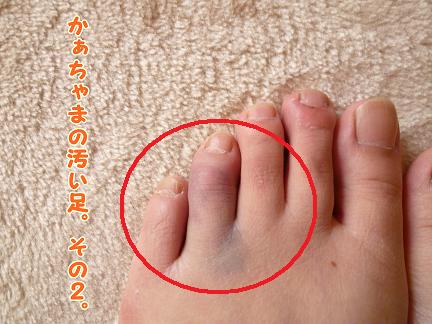 名誉の負傷・・・