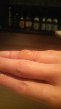 火傷 2012/02/12 21:59:48
